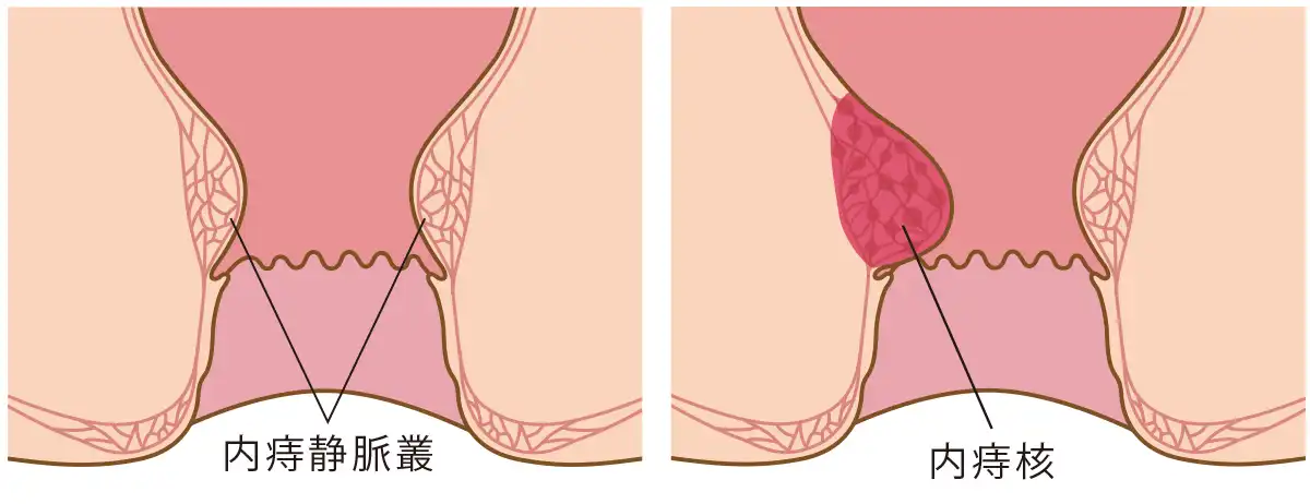 内痔核と内痔静脈叢のイラスト