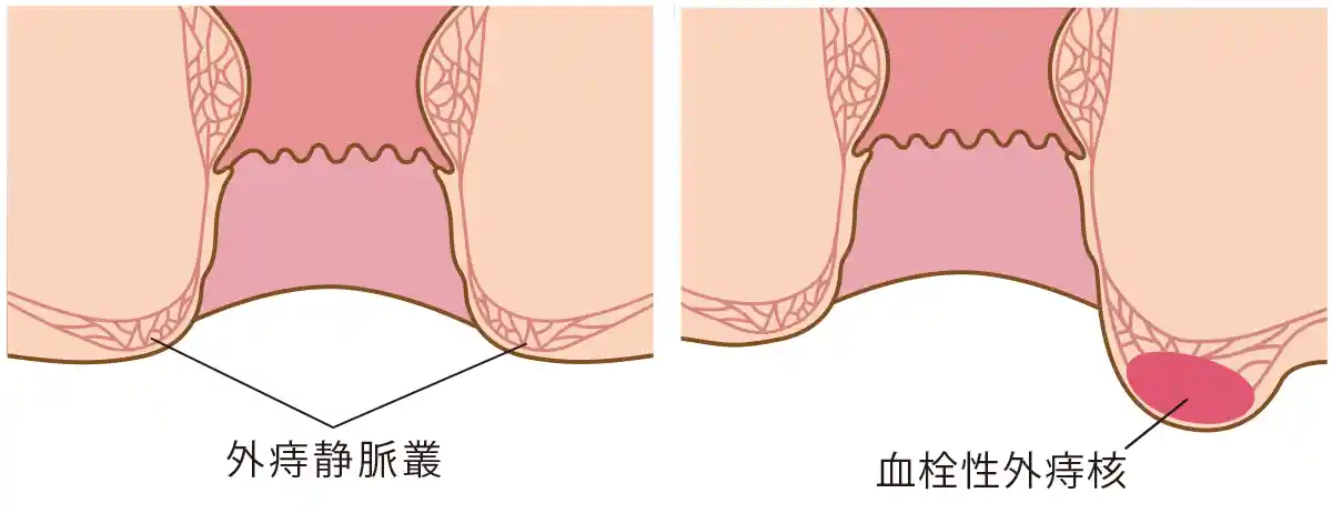 外痔核と外痔静脈叢のイラスト
