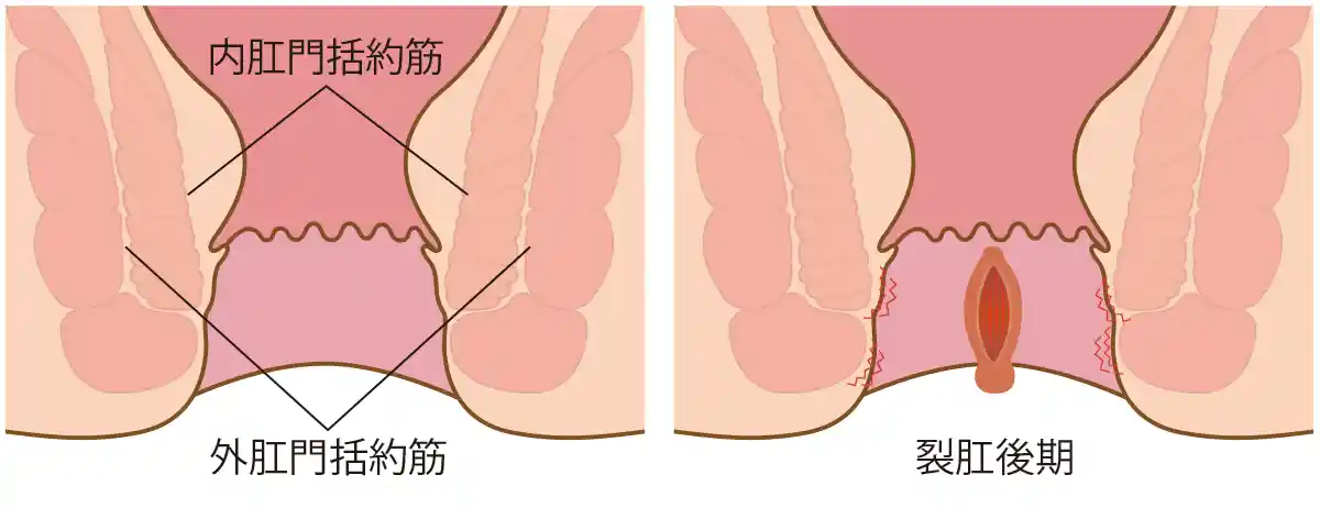 裂肛と肛門括約筋のイラスト