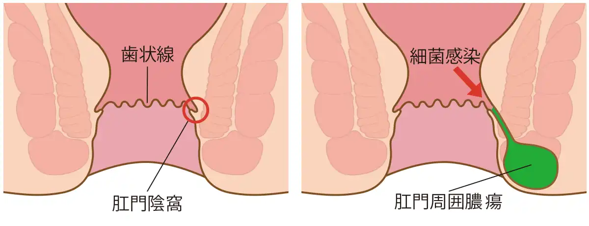 肛門周囲膿瘍/痔ろうと歯状線のイラスト