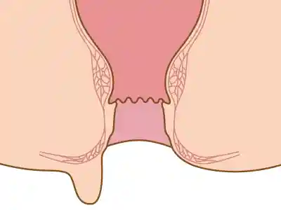 肛門皮垂（スキンタグ）