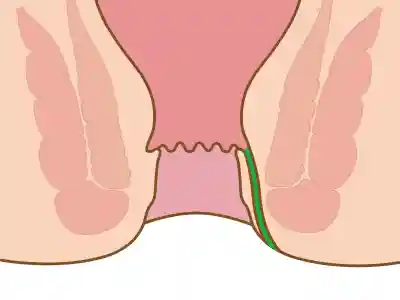 皮下粘膜下痔ろう